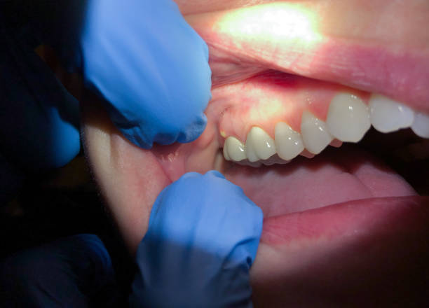 Best Tooth Infection Emergency Dentist  in Monroe, NC